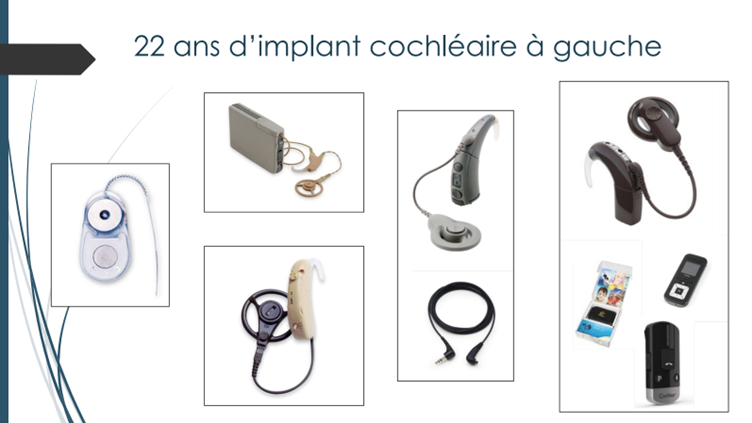 Slide 22 ans d'implant cochléaire à gauche